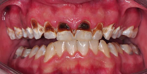 Before and After at Dakota Smiles!