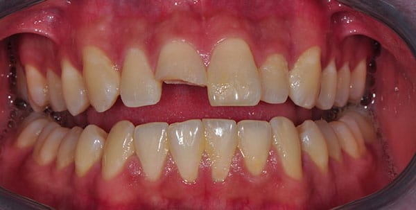 Before and After at Dakota Smiles!