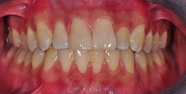 Before and After at Dakota Smiles!
