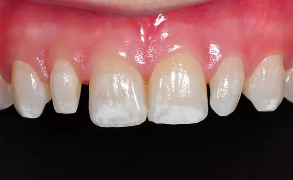 Before and After at Dakota Smiles!