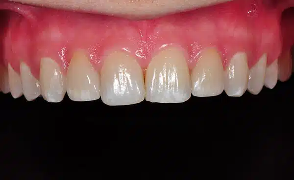 Before and After at Dakota Smiles!