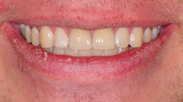 Before and After at Dakota Smiles!