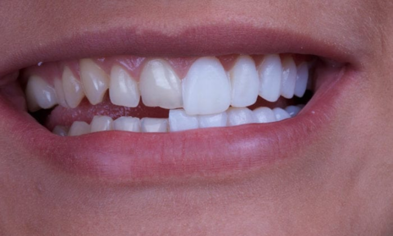 Veneers in Fargo