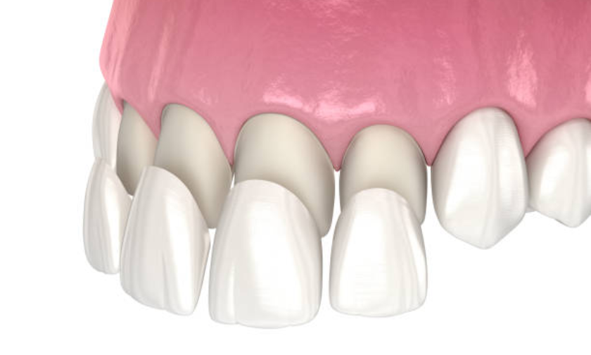 How to Know if Veneers Are Right for You