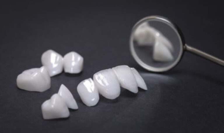Veneers in Fargo