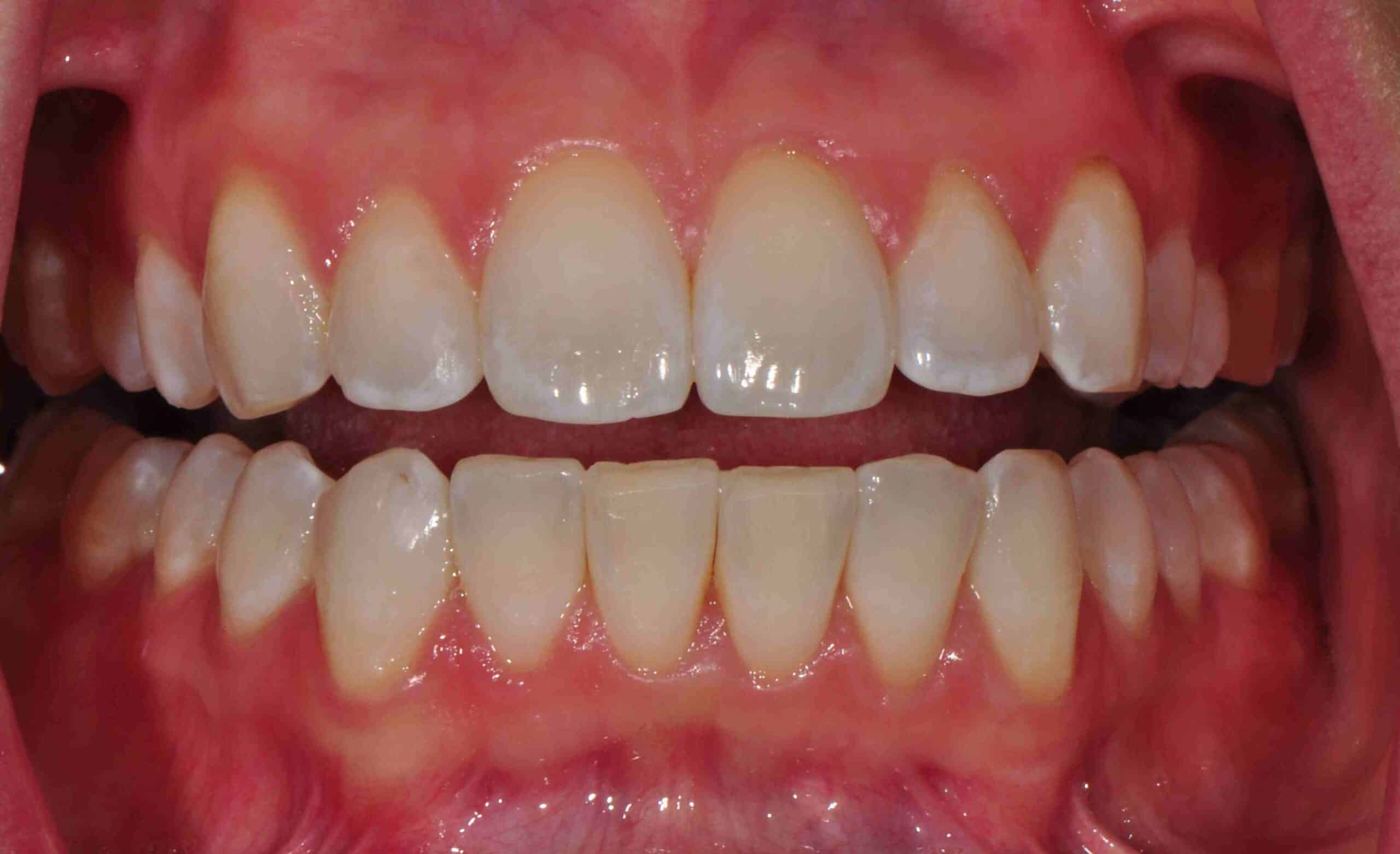 Before and After at Dakota Smiles!