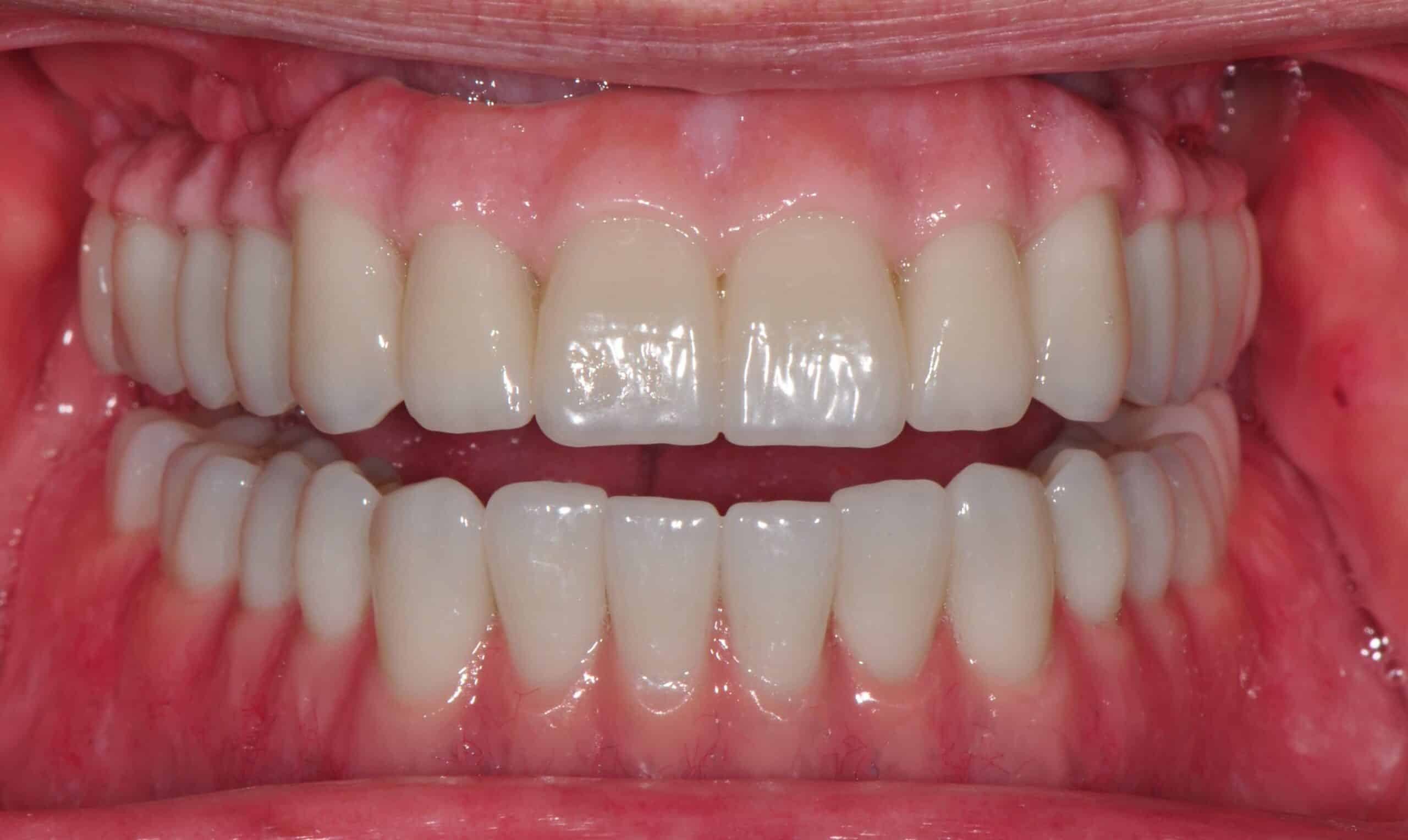 Before and After at Dakota Smiles!