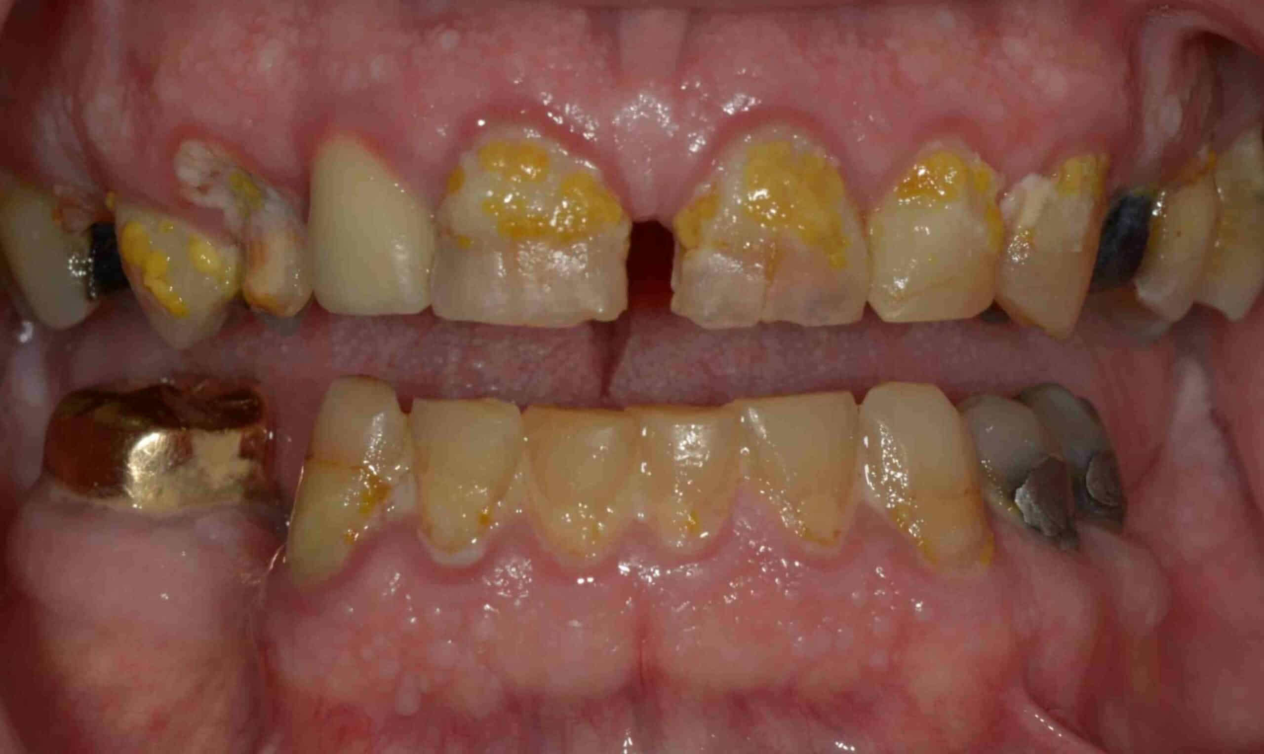 Before and After at Dakota Smiles!