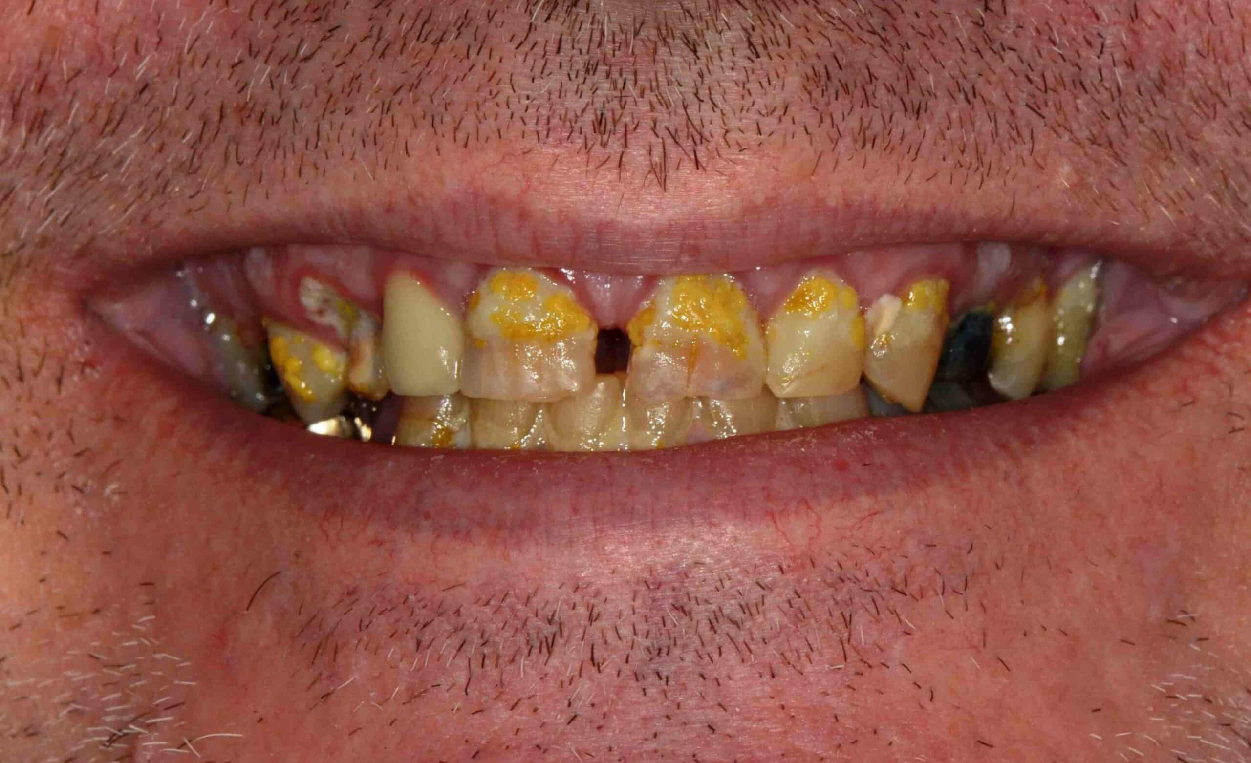 Before and After at Dakota Smiles!