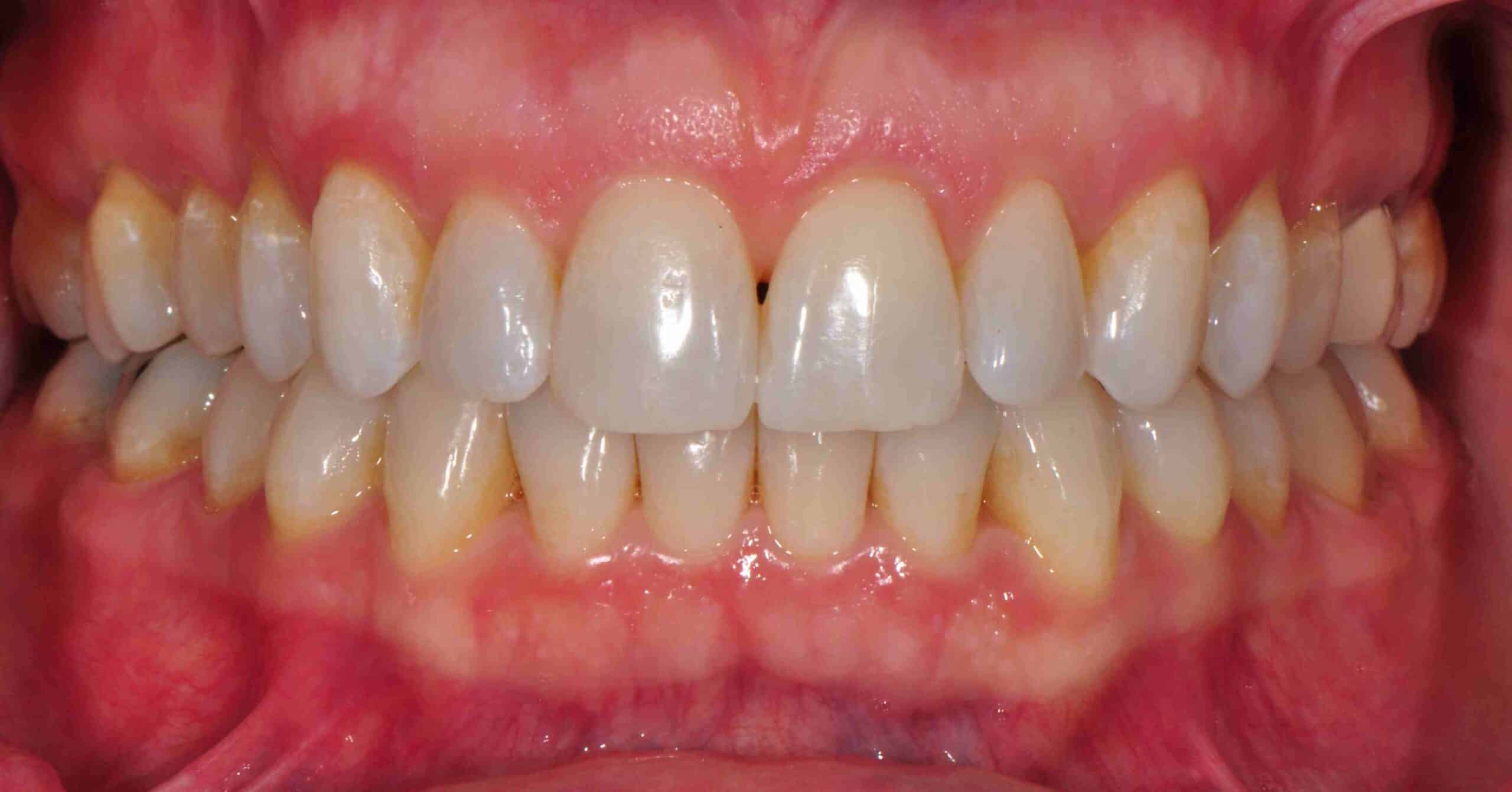 Before and After at Dakota Smiles!