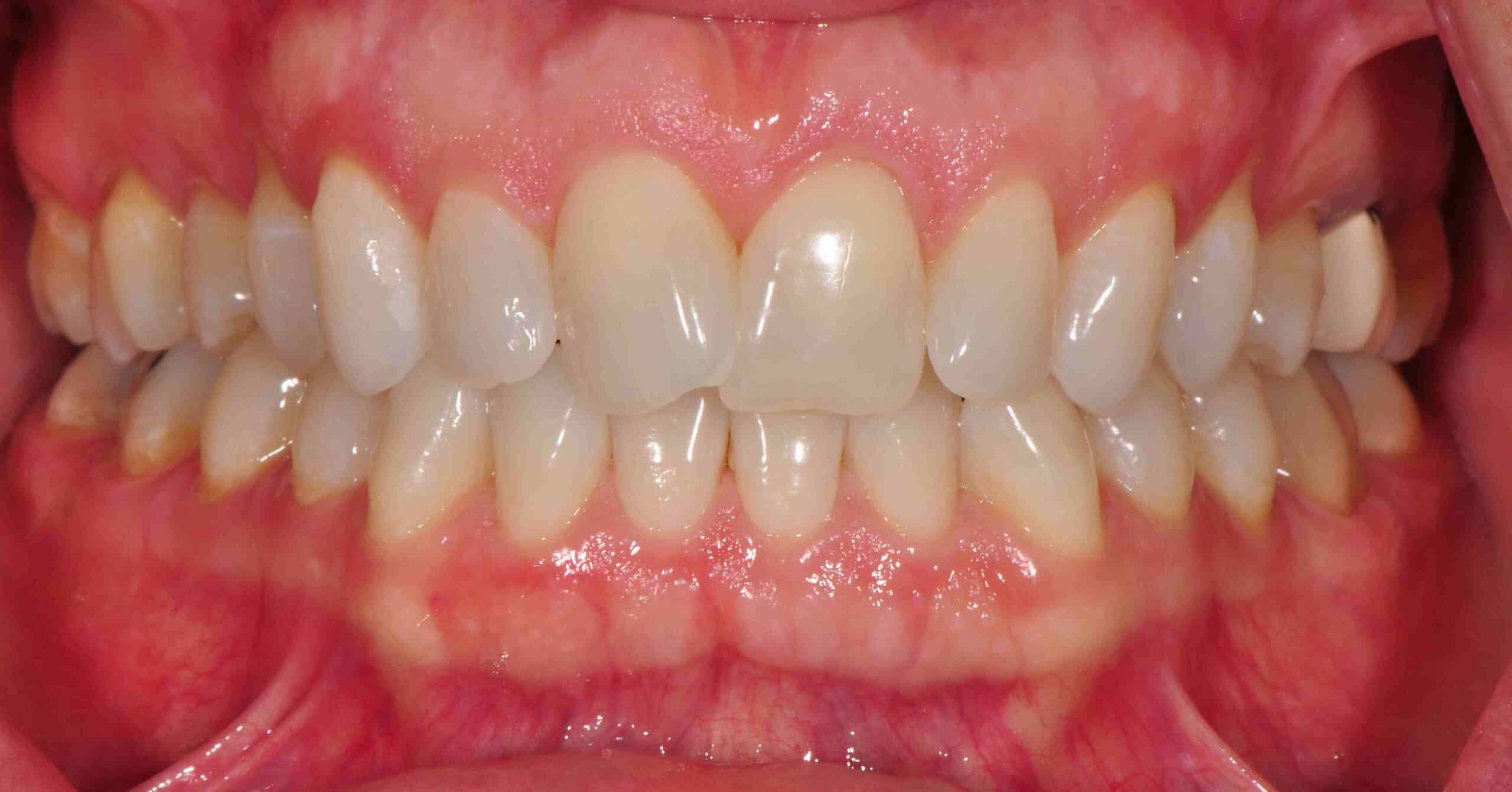 Before and After at Dakota Smiles!