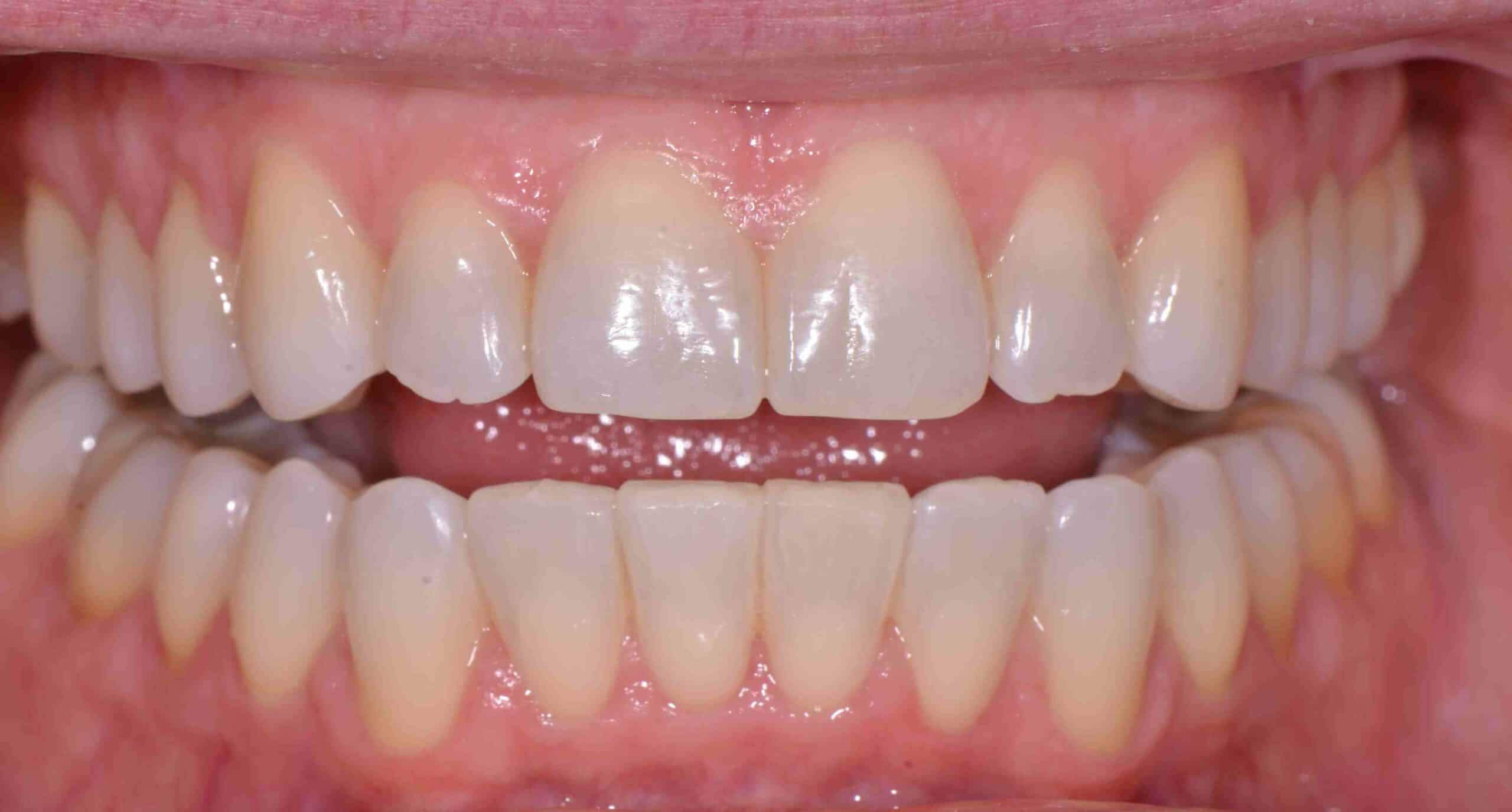 Before and After at Dakota Smiles!