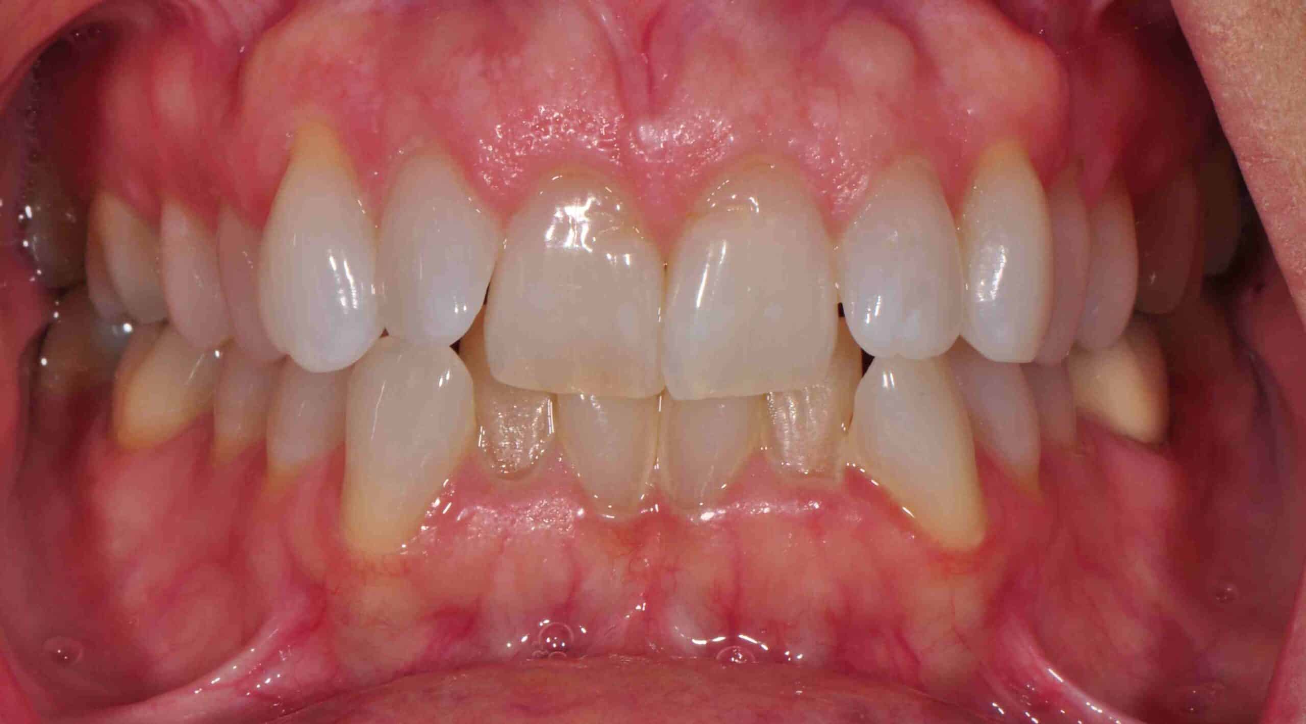 Before and After at Dakota Smiles!