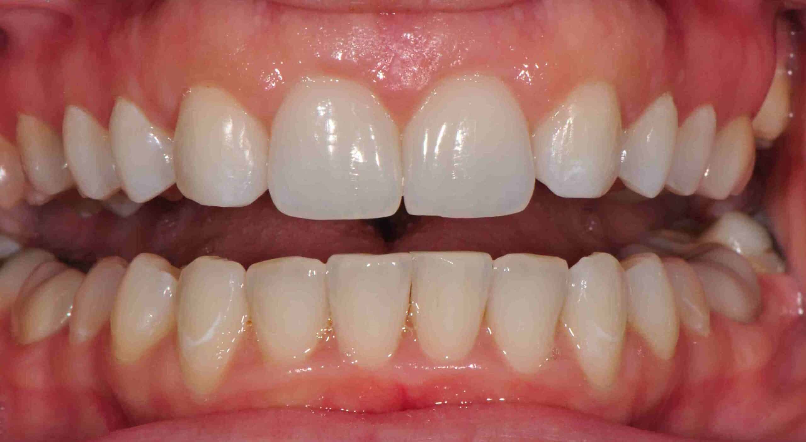 Before and After at Dakota Smiles!