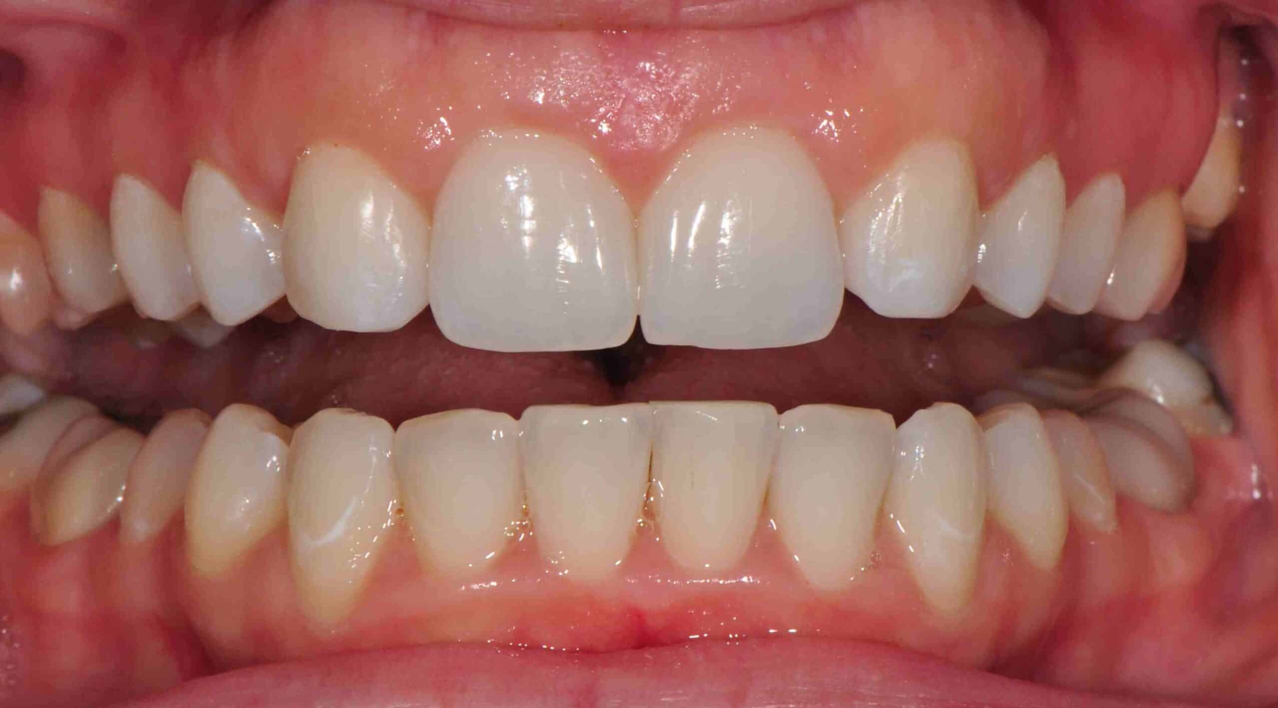 Before and After at Dakota Smiles!