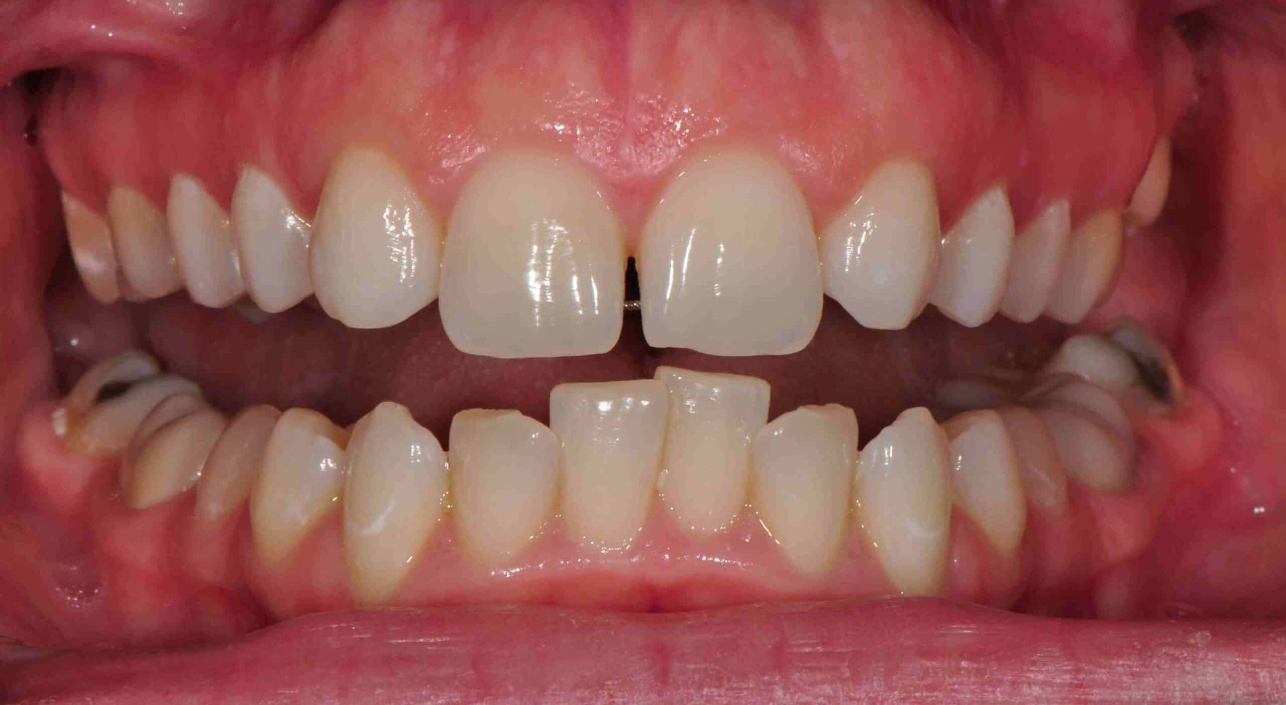 Before and After at Dakota Smiles!