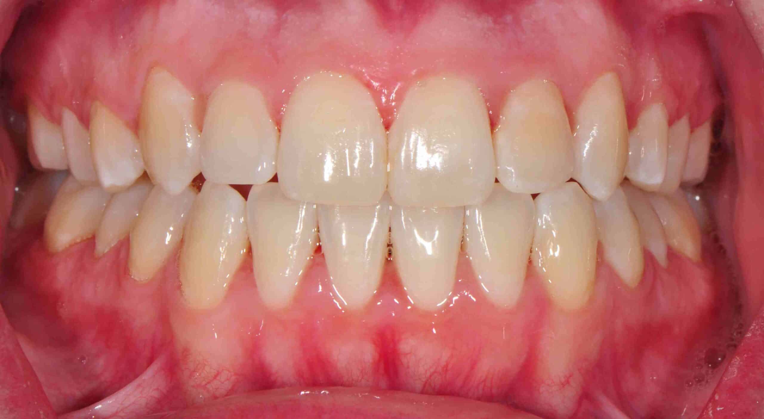 Before and After at Dakota Smiles!