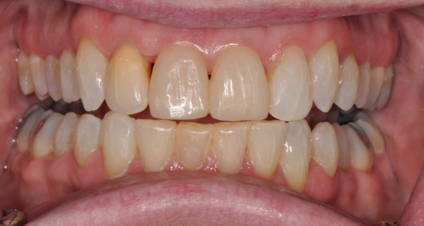Before and After at Dakota Smiles!