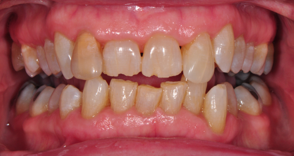 Before and After at Dakota Smiles!