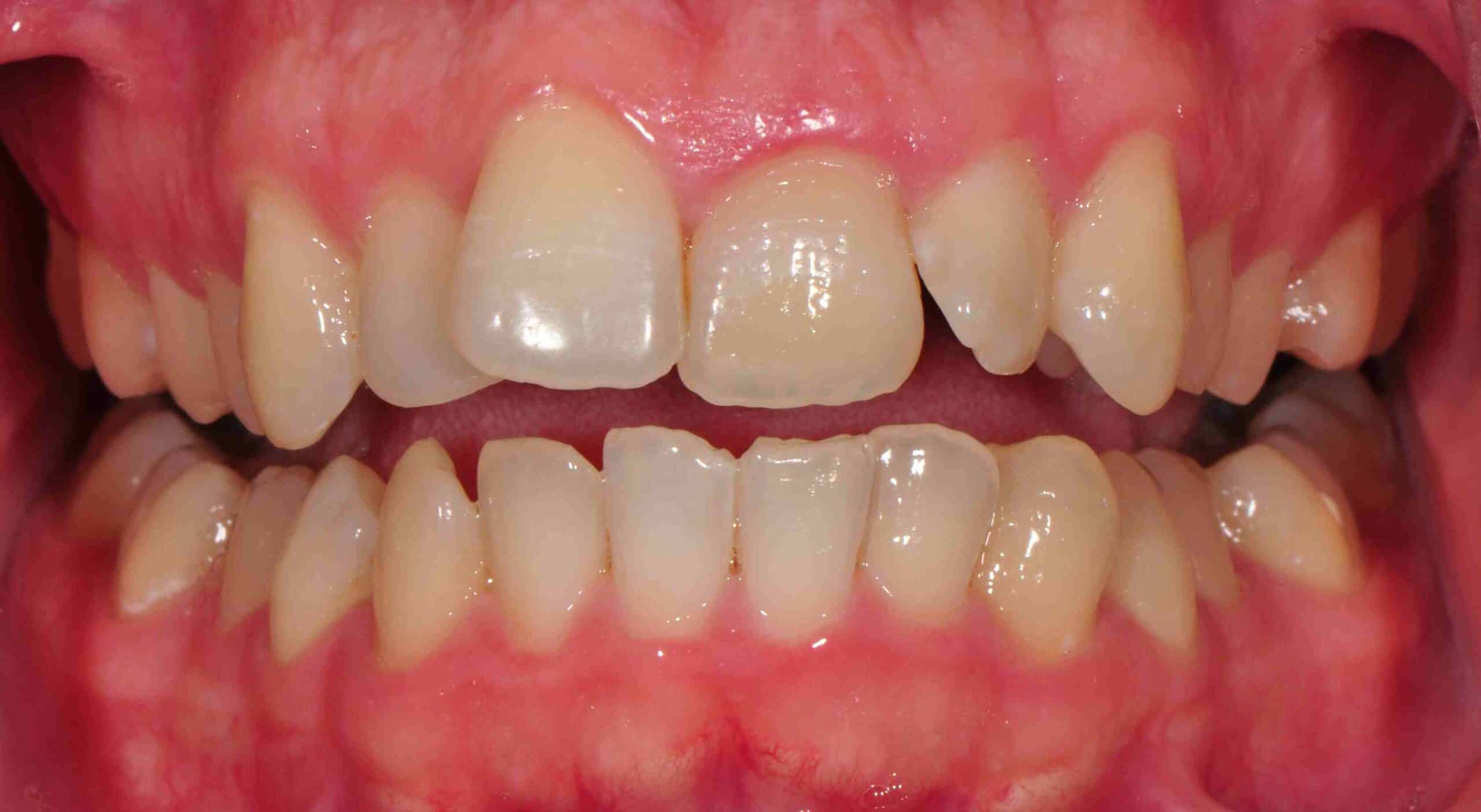 Before and After at Dakota Smiles!
