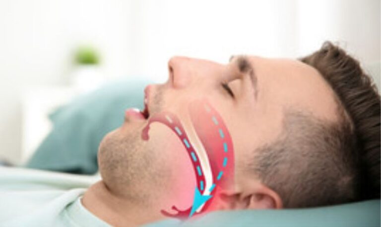 Sleep Apnea in Fargo