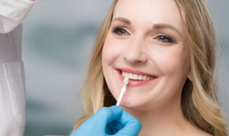 Dental Veneers in fargo