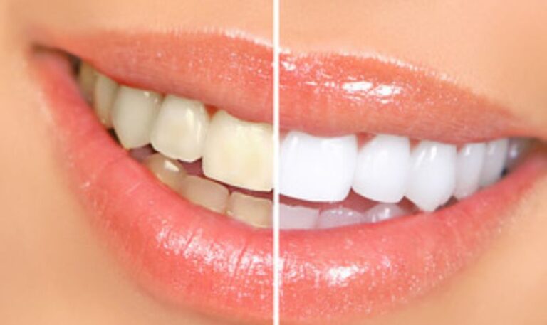 Teeth Whitening in Fargo