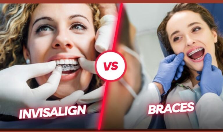 Invisalign vs Braces