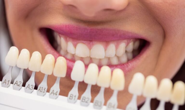 Teeth Whitening in Fargo, ND