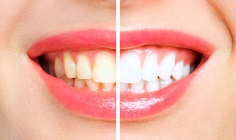 Teeth Whitening in Fargo