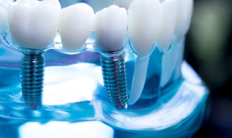 All-on-4 Dental Implants