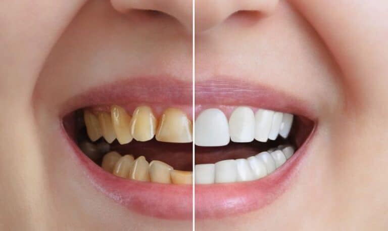 Teeth Whitening in Fargo