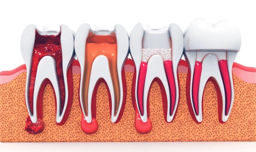 Root Canals