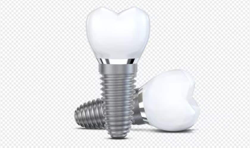Advantages of Same Day Dental Implants