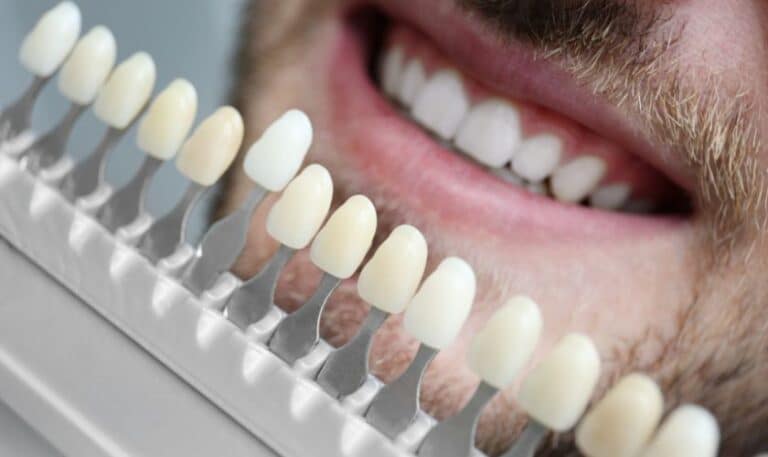 Choosing The Right Dentist For Your Veneers: Factors To Consider