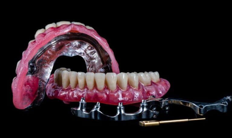 What Is All On Four Dental Implant, And How Does It Work?