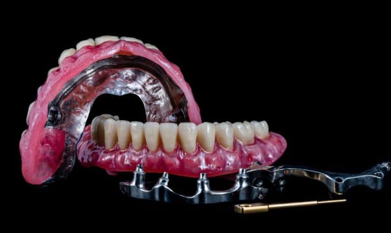 What Is All On Four Dental Implant, And How Does It Work?