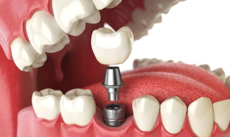 Advantages And Disadvantages Of Dental Implants