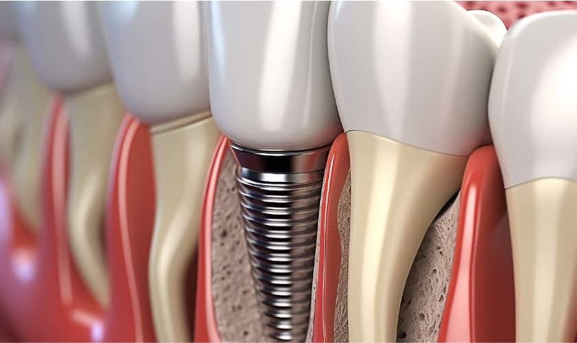 Dental implant cross-section showing titanium screw fixture embedded in jawbone with crown restoration.