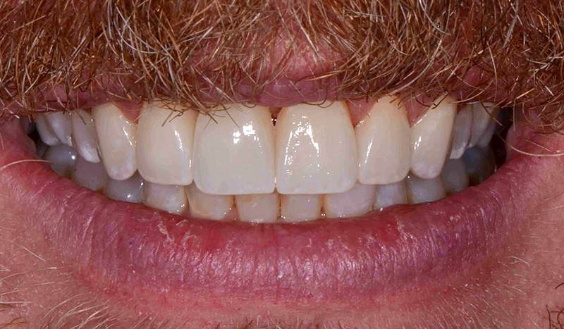 Before and After at Dakota Smiles!