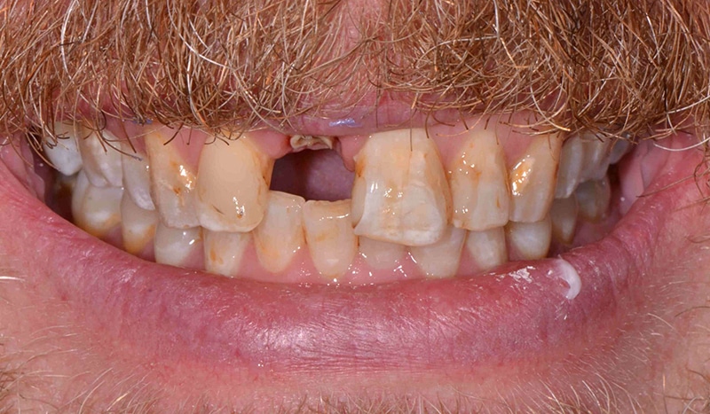 Before and After at Dakota Smiles!