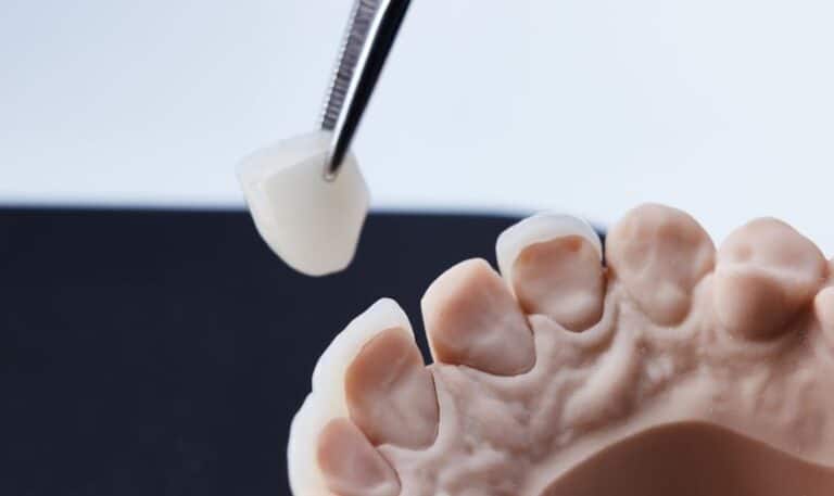 dental veneers