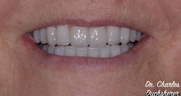 Before and After at Dakota Smiles!
