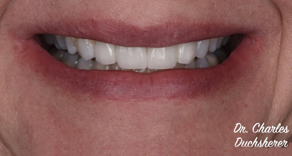 Before and After at Dakota Smiles!