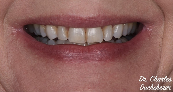 Before and After at Dakota Smiles!