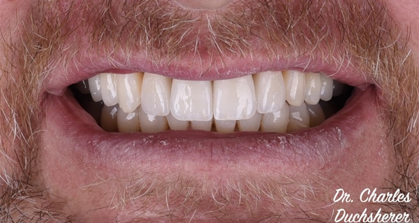 Before and After at Dakota Smiles!