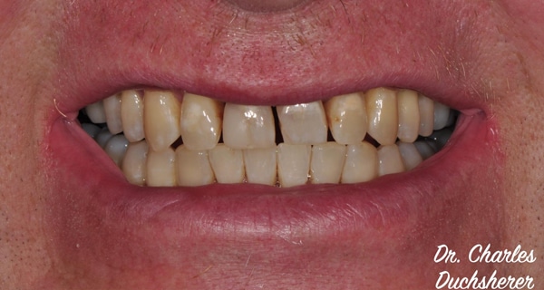 Before and After at Dakota Smiles!