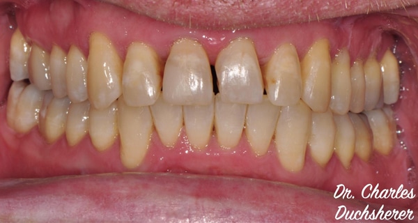 Before and After at Dakota Smiles!