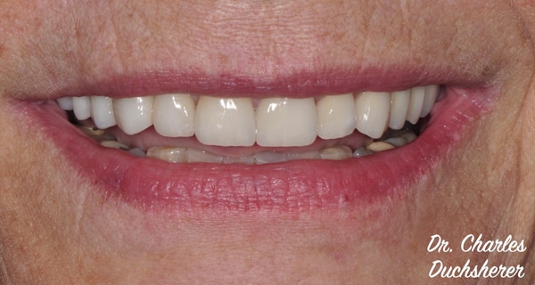 Before and After at Dakota Smiles!