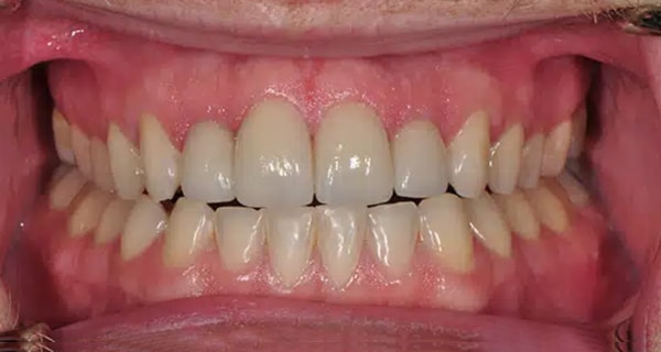 Before and After at Dakota Smiles!